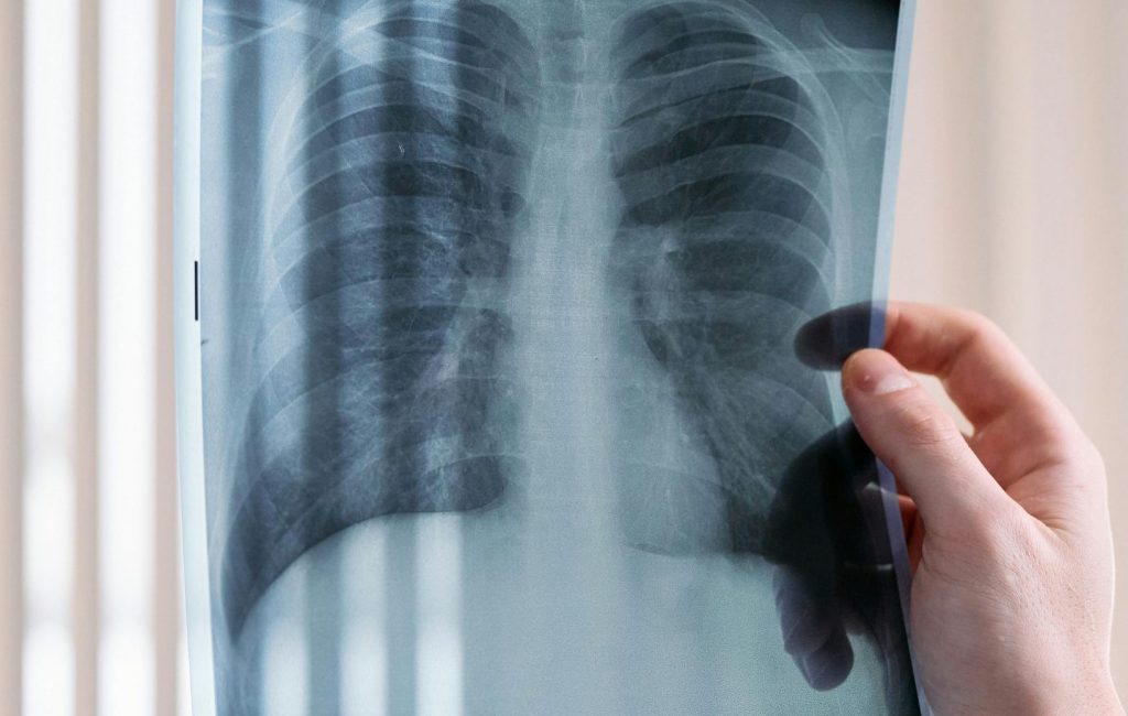 Breathing New Life into Cocoa Farming Communities: The Importance of Lung Screenings